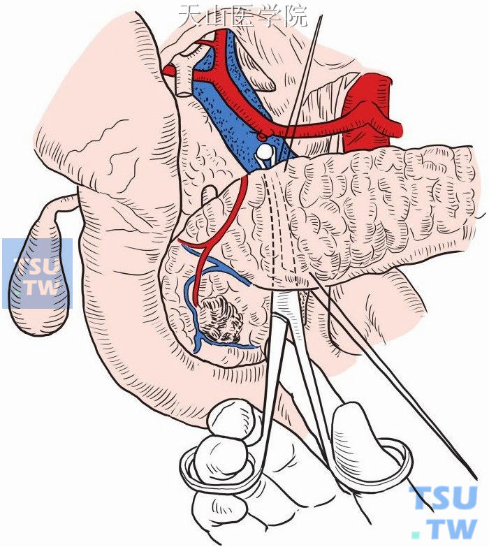 胰腺上下缘各缝合一针