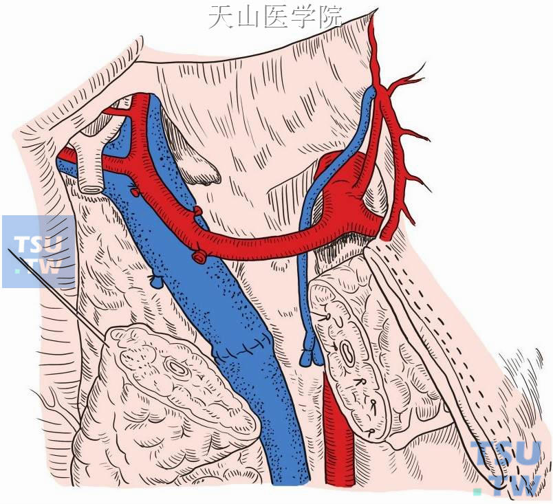 门静脉局段切除后重建