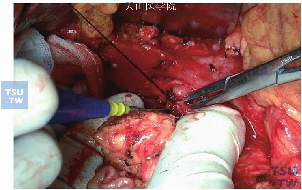 切断胰腺与肠系膜上动脉间的联系血管