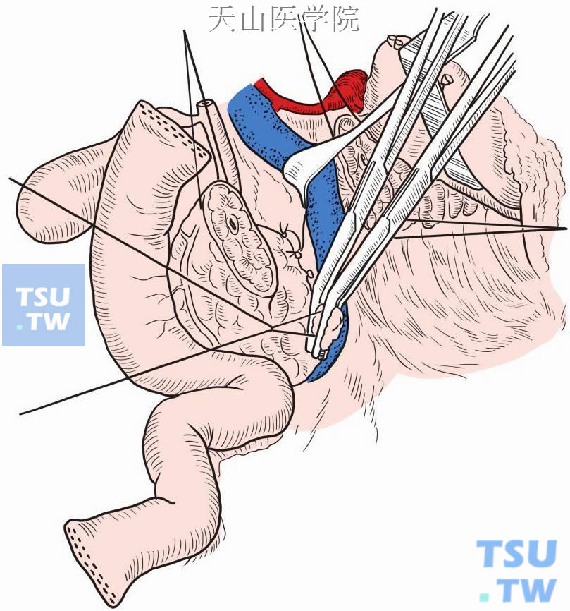 切断胰腺与肠系膜上动脉间的联系血管示意图
