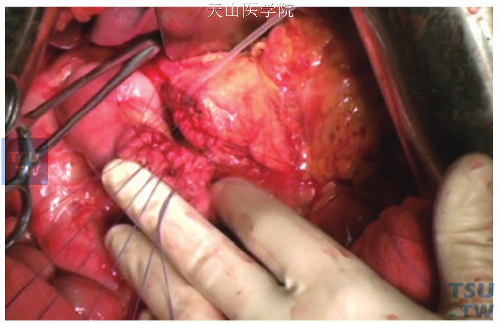 胰腺空肠后壁内层缝合，主胰管内放置支架管