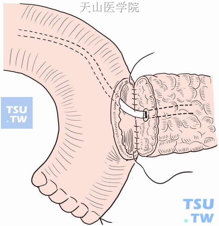 胰腺空肠后壁内层缝合，主胰管内放置引流管留置于空肠腔内