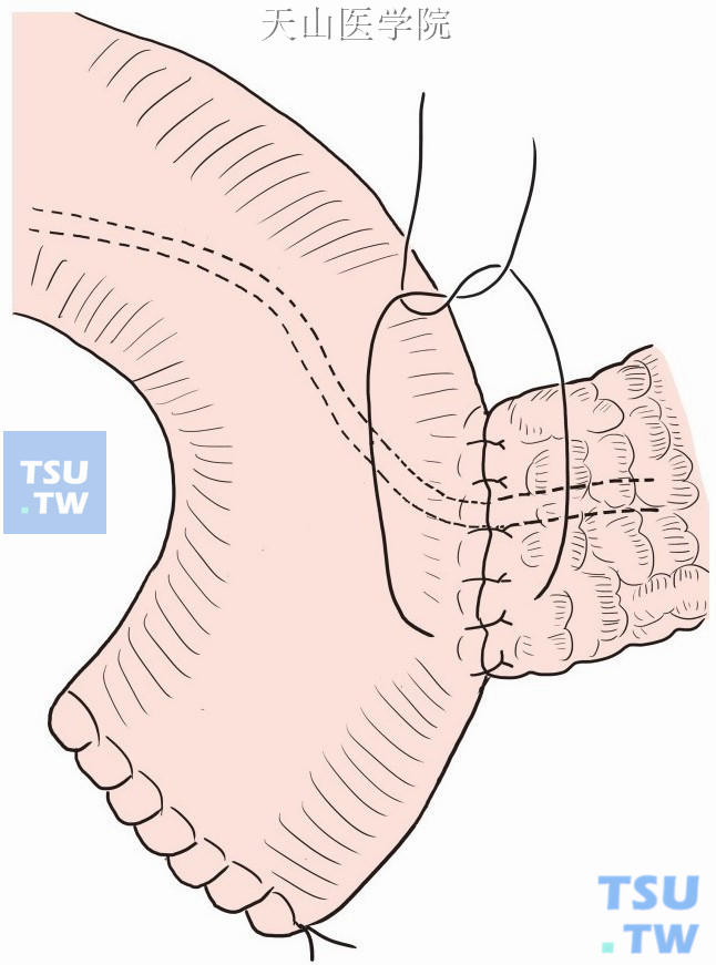 胰腺空肠吻合口后壁浆肌层加强