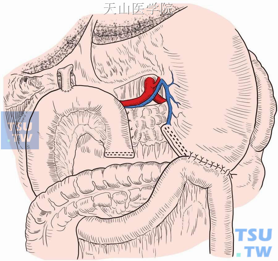 方法同常规胃肠道吻合，可以采用手工缝合或吻合器机械缝合