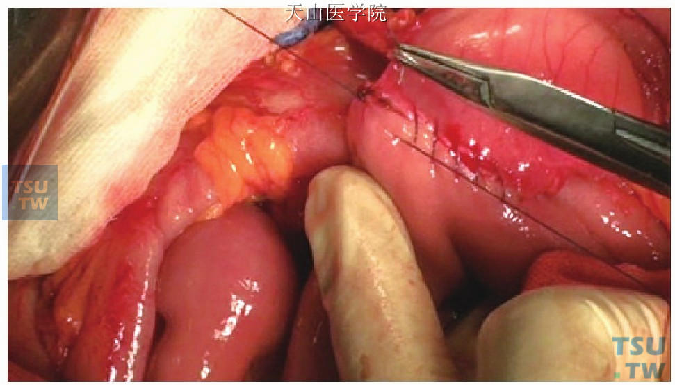 消化道重建：多采用Child式。十二指肠与空肠端侧吻合多采用手工缝合（3-0或4-0可吸收缝线，连续缝合）