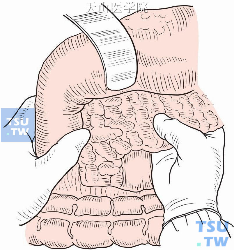 游离胰腺后方间隙，将胰体尾部捏于手中仔细探查