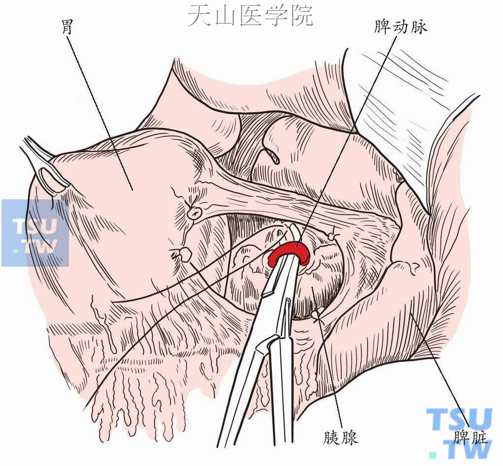 胰腺上缘显露脾动脉，近根部结扎