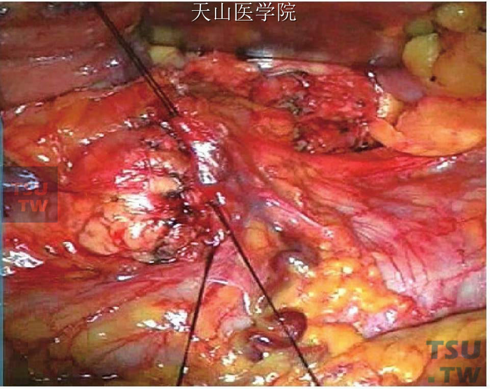 胰腺残端以邻近横结肠系膜覆盖缝合结扎固定