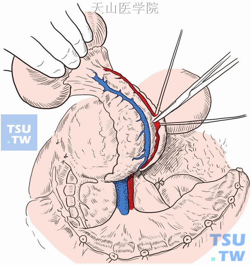 脾动脉近根部丝线结扎+缝扎处理后切断