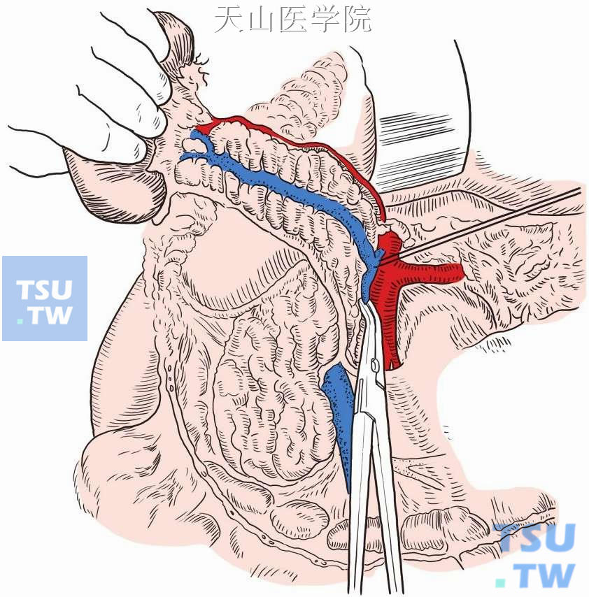 脾静脉在肠系膜下静脉汇合前离断