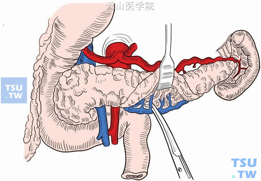 胰腺后方显露脾静脉及分支血管