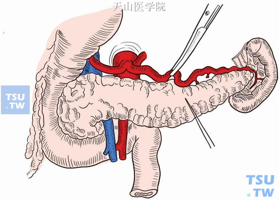 胰腺上缘显露脾动脉主干及分支