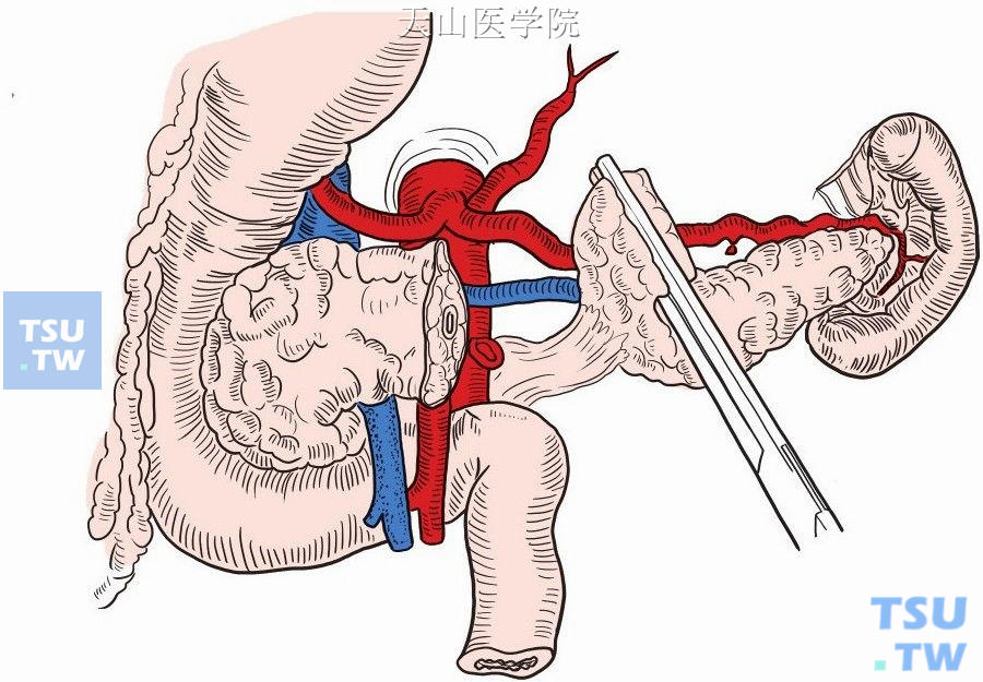 牵拉远侧胰腺断端，仔细分离脾动、静脉于胰腺体尾部之间的小分支，逐支结扎切断，分离至胰尾部，将胰体尾完整切除