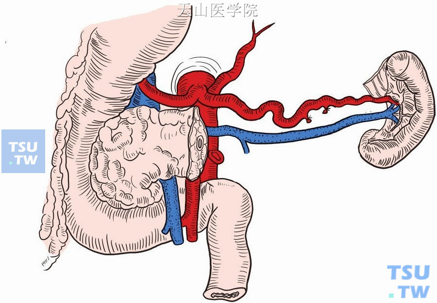 牵拉远侧胰腺断端，仔细分离脾动、静脉于胰腺体尾部之间的小分支，逐支结扎切断，分离至胰尾部，将胰体尾完整切除
