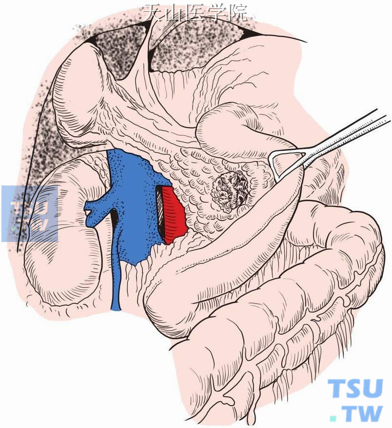 Kocher切口游离胰头十二指肠