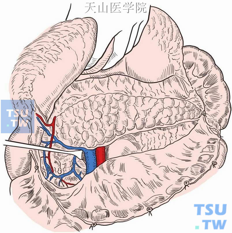 小网膜囊显露，探查胰腺、肠系膜上血管