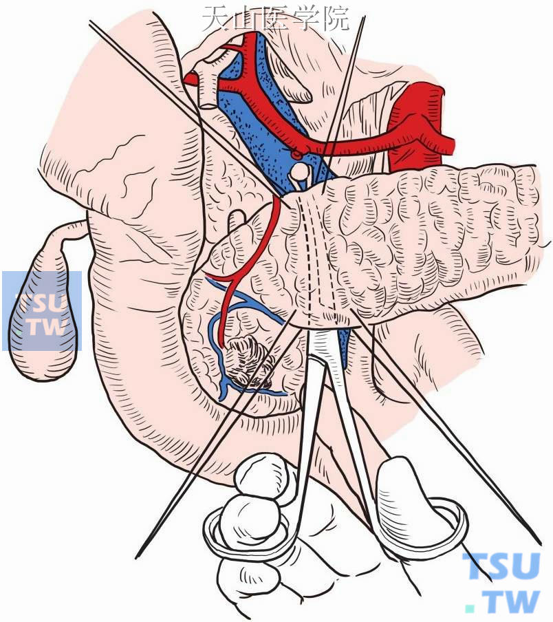 在胰腺后方与肠系膜上静脉/门静脉之间分离通过