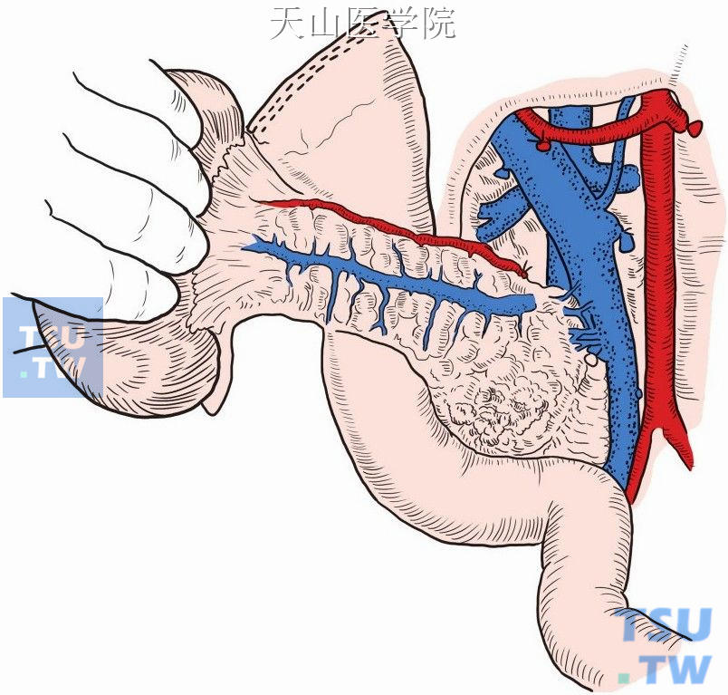 胰腺钩突部血管结扎