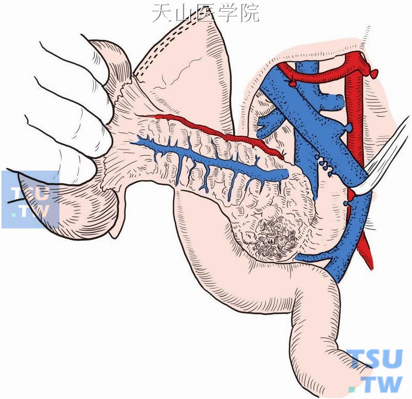 胰腺钩突部血管离断