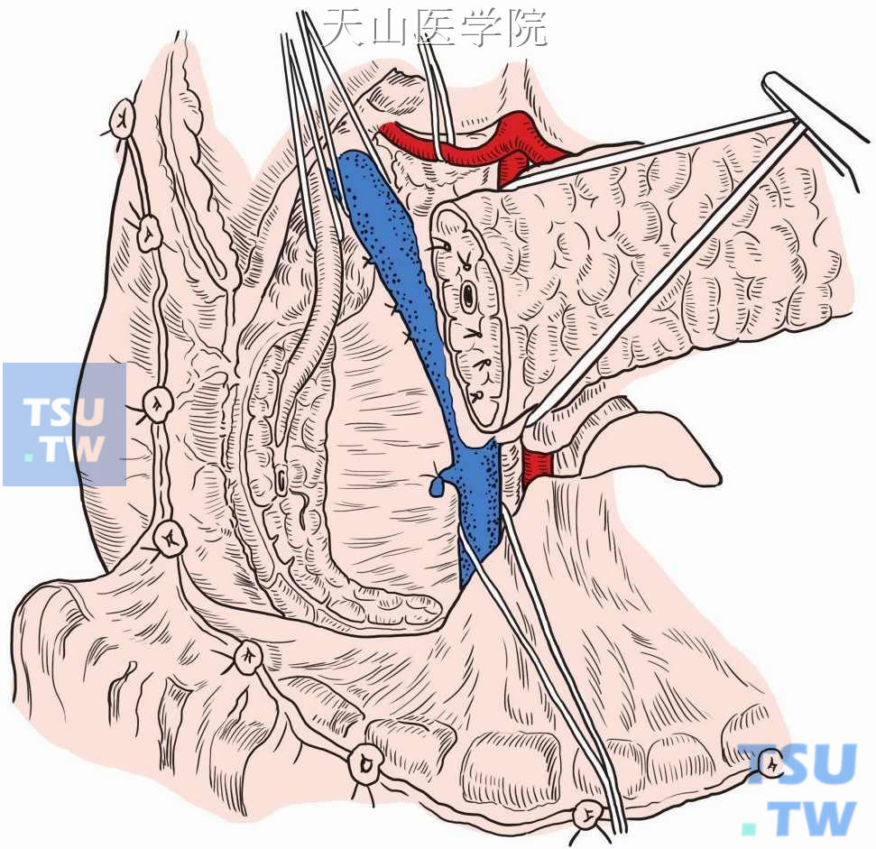 门静脉—肠系膜上静脉前方横断胰颈，保留胆总管、十二指肠的胰头组织次全切除术