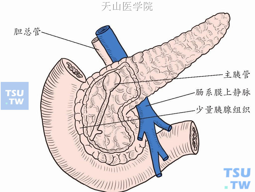 胰头局部切除后示意图