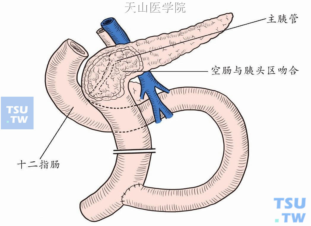 胰腺空肠Roux-en-Y吻合示意图