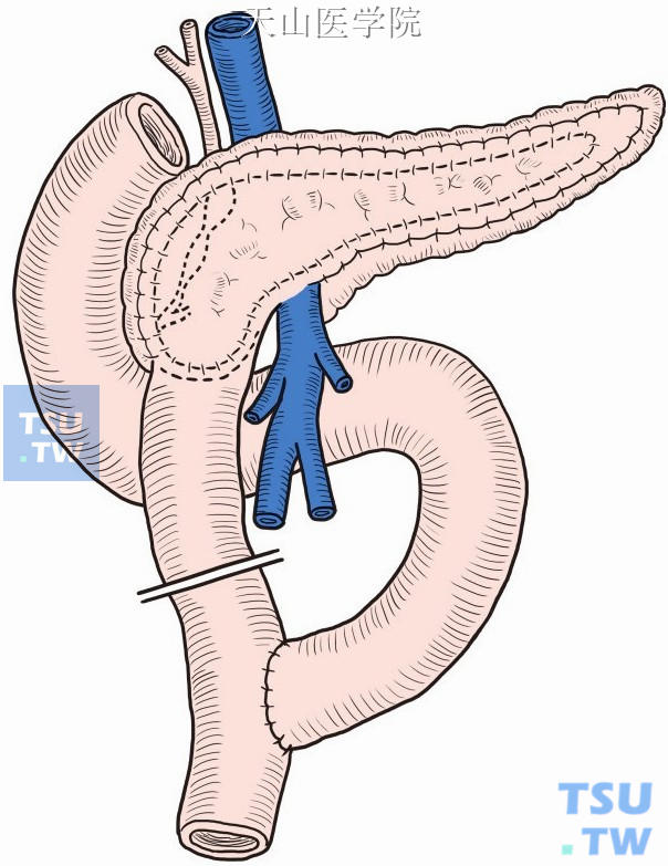 胰头局部切除+胰管纵行切开减压，胰腺创面空肠吻合