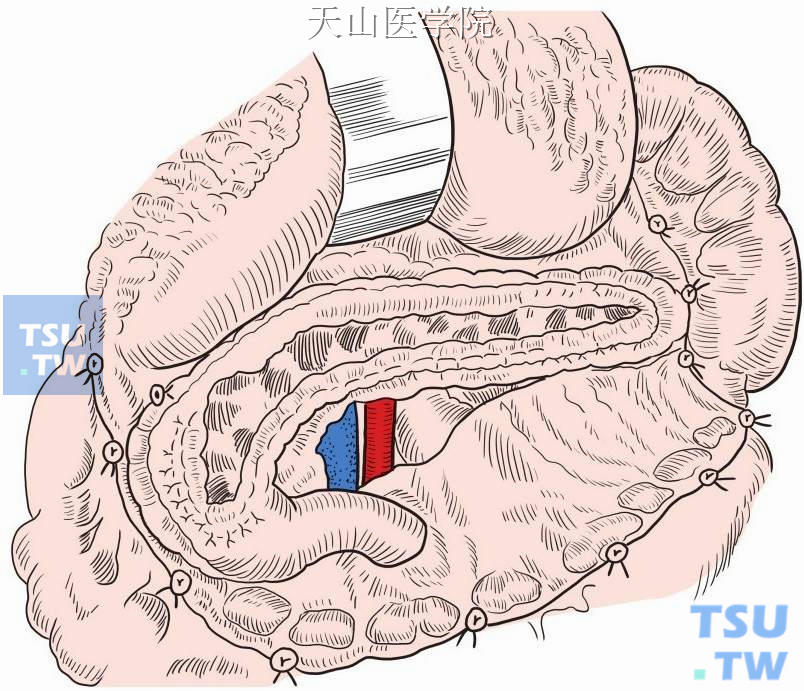 Roux-en-Y式肠襻与整个胰管做侧侧全口吻合
