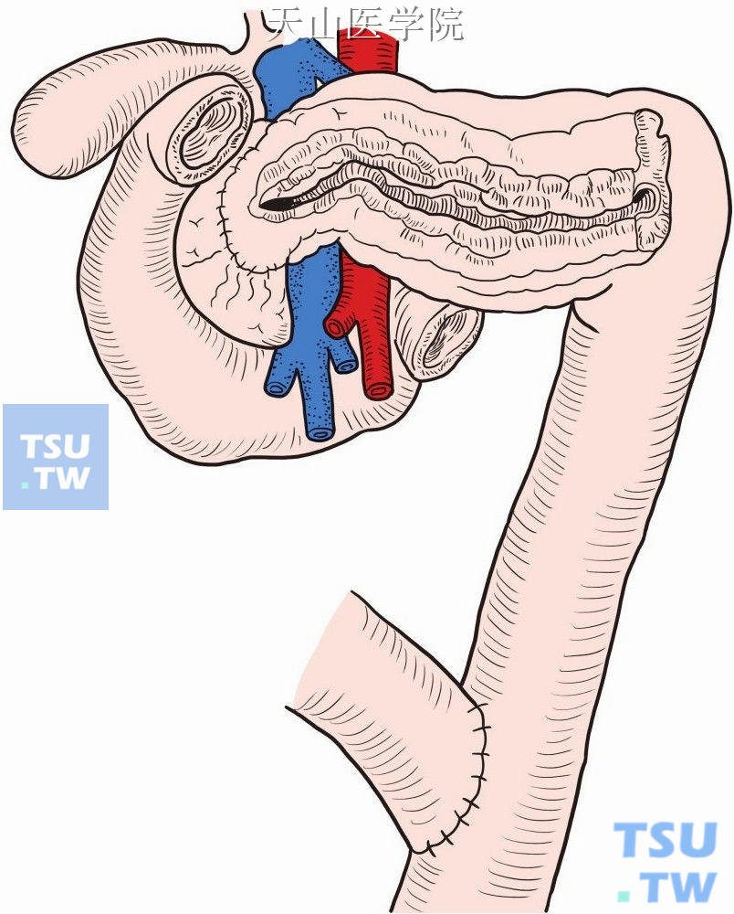 空肠缝合到右侧切开的胰腺上（胰管空肠吻合术）前面观。结肠系膜下方行Roux-en-Y肠吻合术