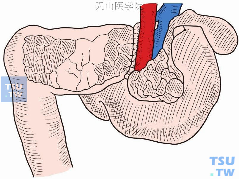 空肠缝合到肠系膜上血管左侧的胰周组织之后面观