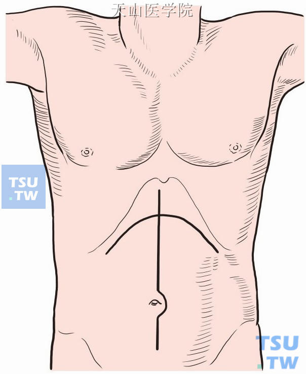 取上腹部正中切口至脐下5cm，或上腹部弧形切口