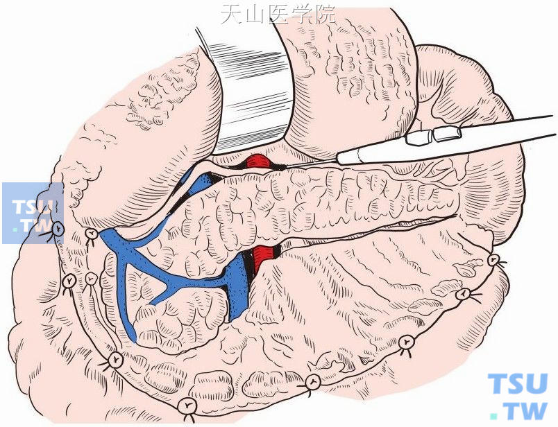 打开胃结肠韧带，进入网膜囊，暴露胰腺。沿着胰腺上下缘分别打开胰腺被膜