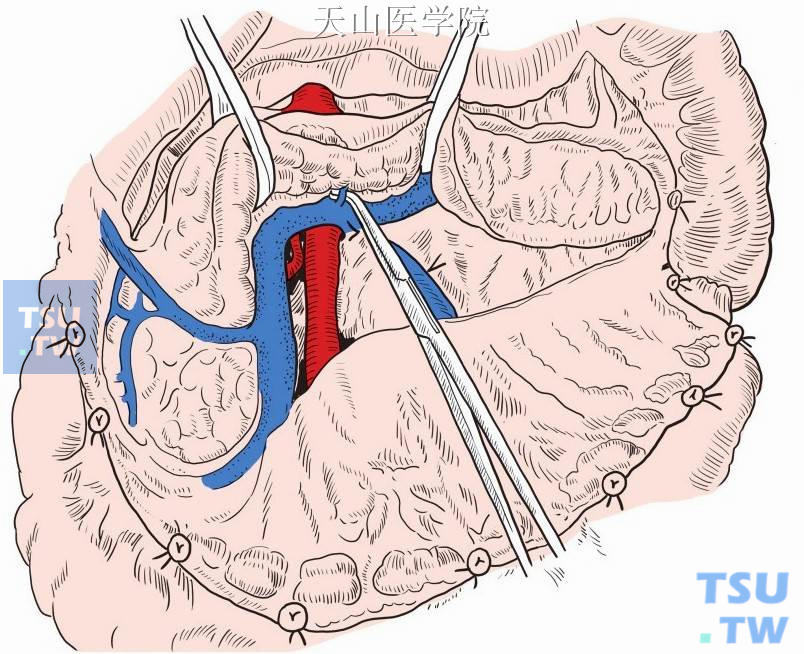 于胰腺上下缘沿胰腺轮廓，打开后腹膜，解剖暴露肠系膜上静脉，于肠系膜上静脉前方分离与胰腺颈部之间间隙，向上分离至胰腺上缘。逐次结扎切断胰腺汇入脾静脉的分支