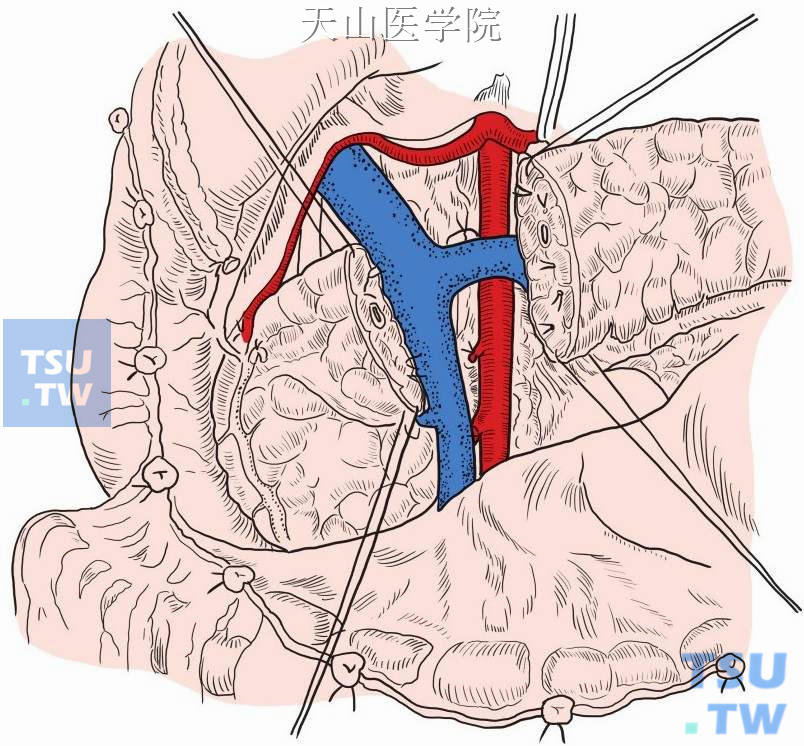 游离胰腺后，于预定线处切断胰腺，胰腺断面出血均予以间断缝合止血