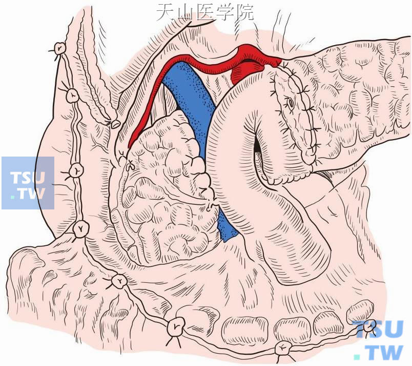 消化道重建方式。远端胰腺残端和空肠行Roux-en-Y消化道重建示意图