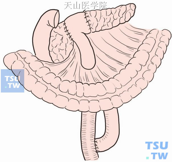 胰腺空肠双吻合（Ω形吻合）
