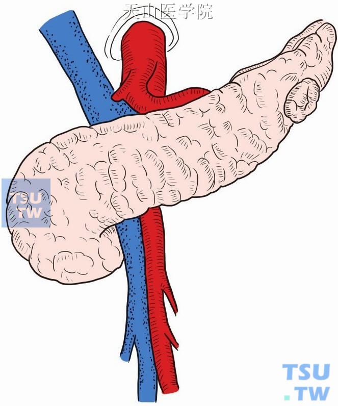 病变位于胰尾表面