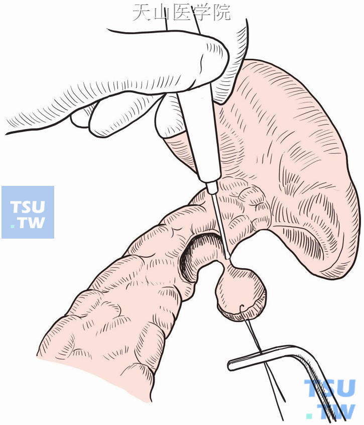 将胰腺病变局部切除