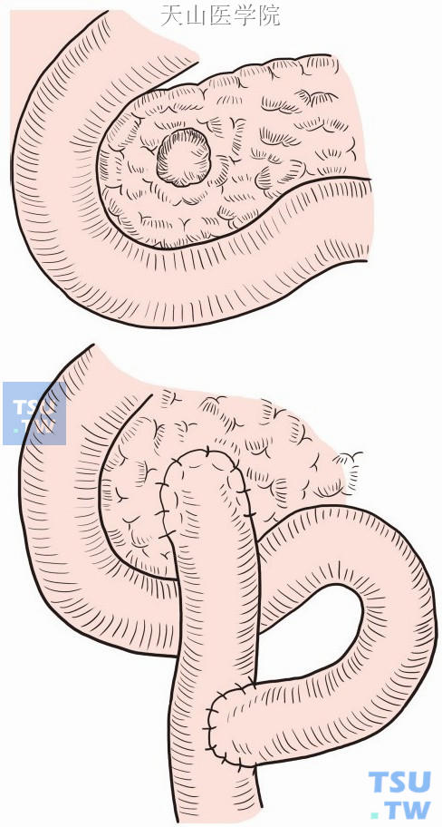 胰头肿瘤局部挖除后，创面和空肠Roux-en-Y吻合