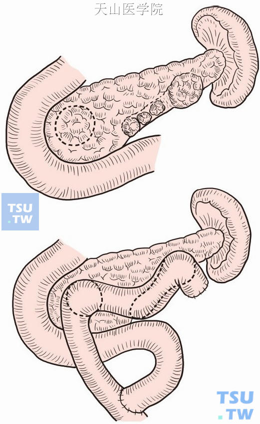 多个胰腺神经内分泌肿瘤局部挖除后，创面和一段Roux-en-Y肠襻连续两个吻合