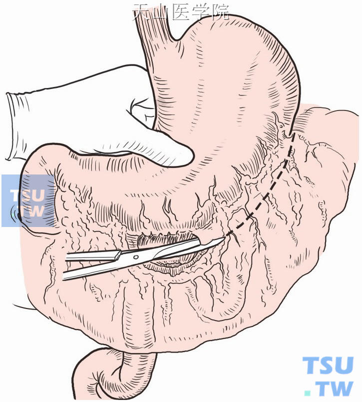 经横结肠上缘无血管区切开胃结肠韧带，进入网膜囊