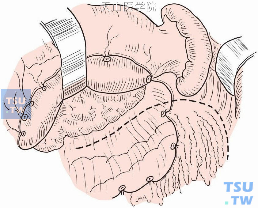 进入网膜囊，贴近胃后壁分离，显露胰腺前方