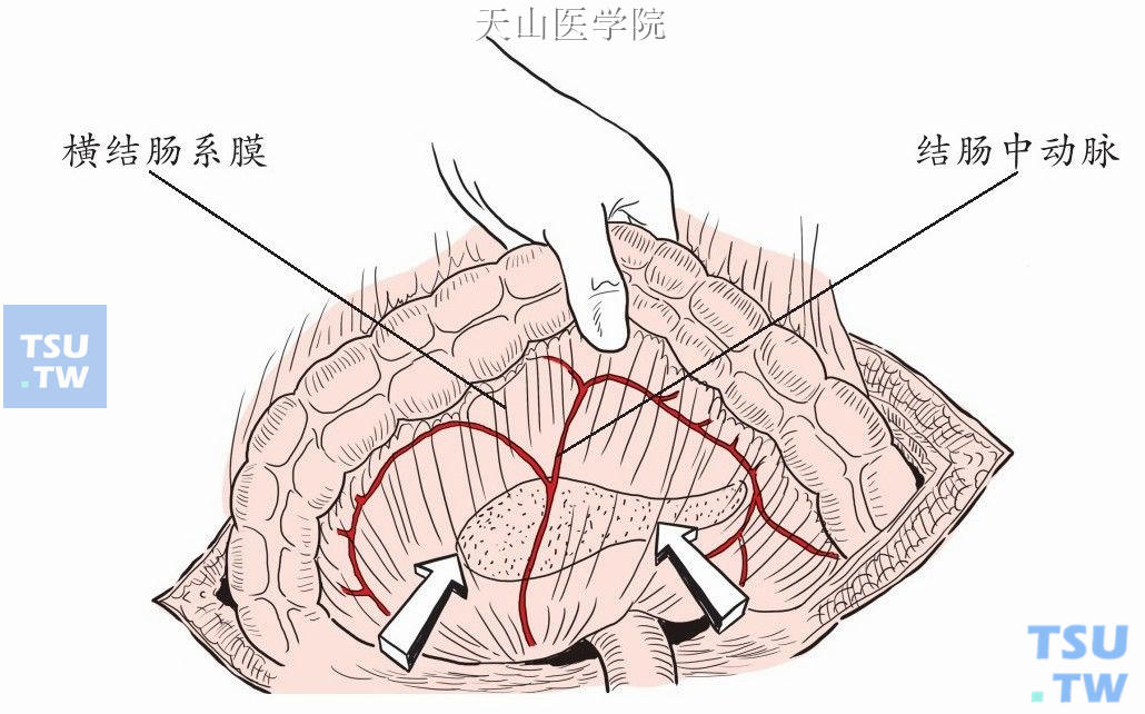 经横结肠系膜途径