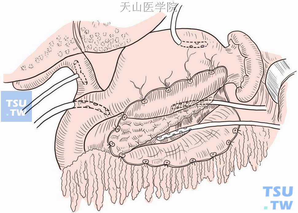 胰腺炎清创引流术