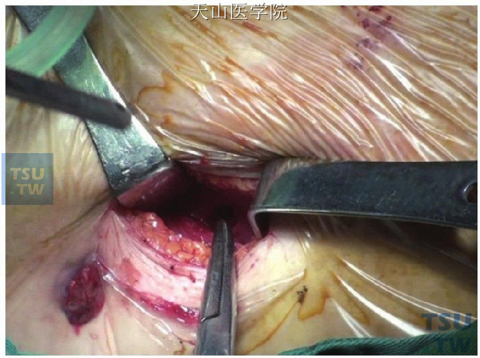 左侧腋中线切口，分离进入结肠后脓腔