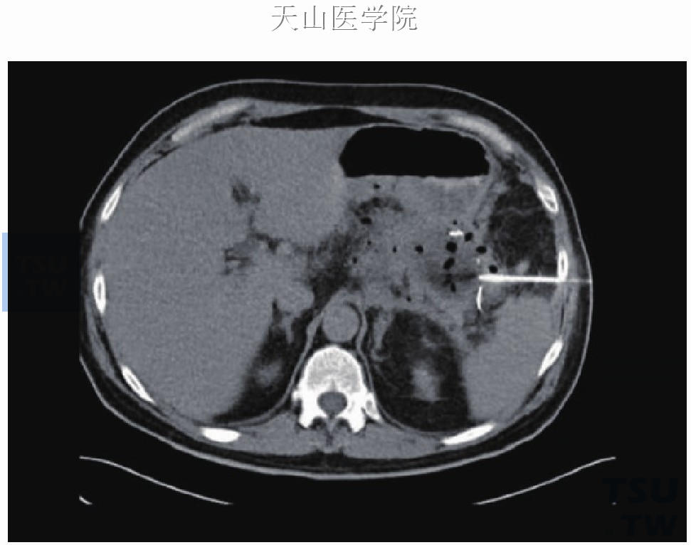 CT引导穿刺进入脓腔