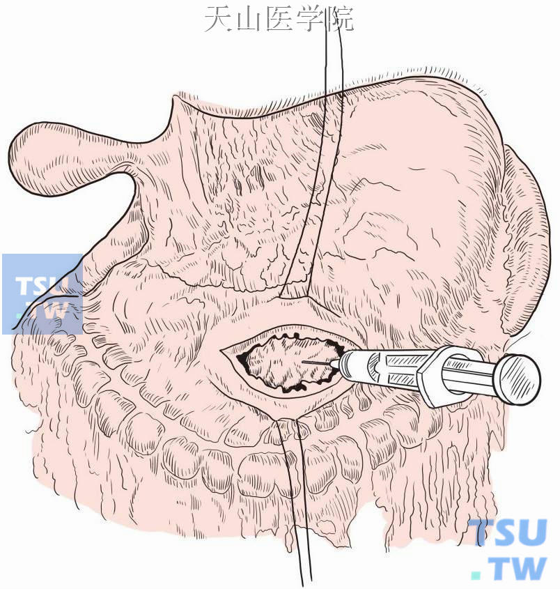 在最突起部位做胃前壁牵引线和切开胃壁，穿刺证实囊肿位置