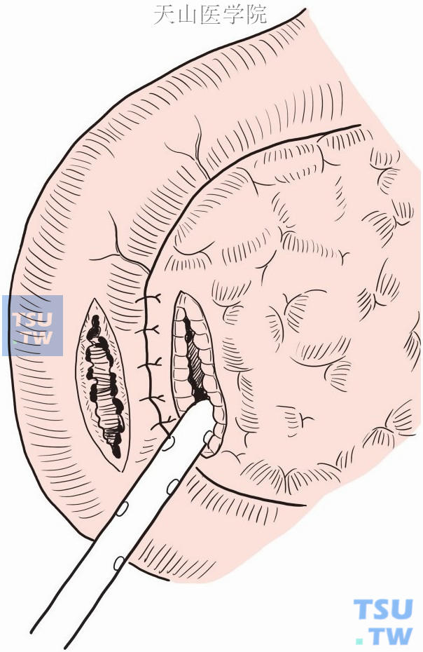 除通过十二指肠后壁和囊肿吻合外，也用采用十二指肠和相应囊肿位置分别梭形切开，全层连续或间断缝合
