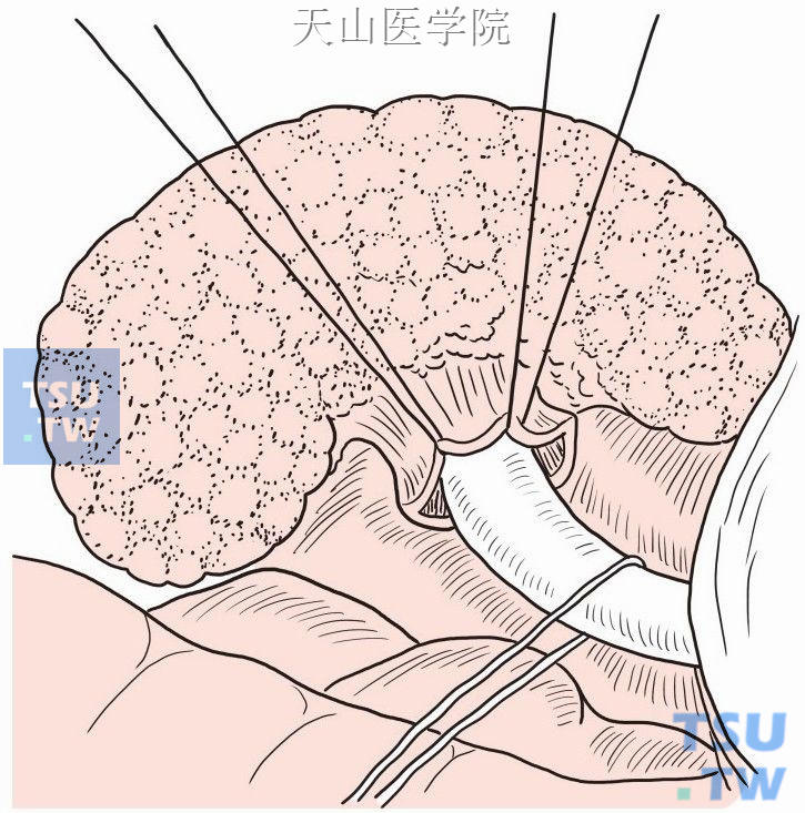 瘘管在引流管导引下分离至基底部