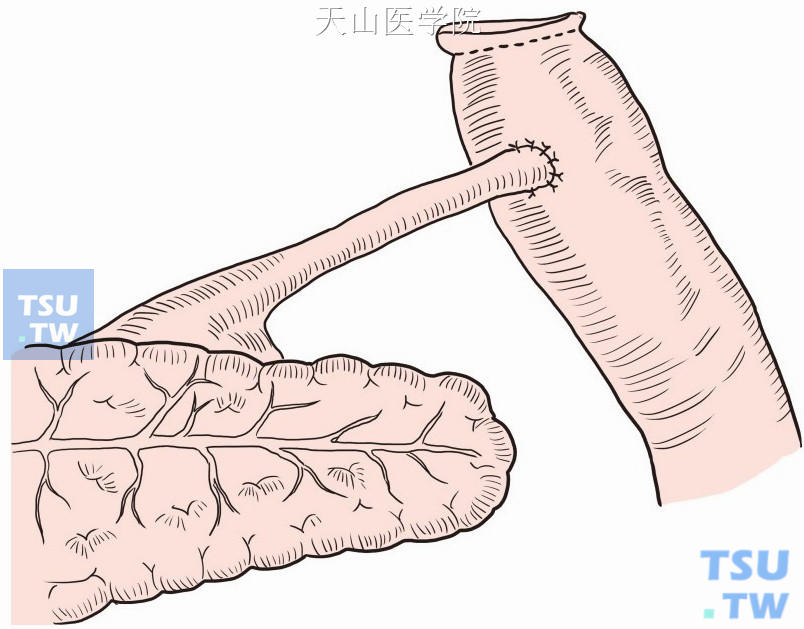 保留瘘管5～6cm，瘘管空肠端侧吻合